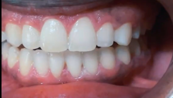 Teeth after professional whitening