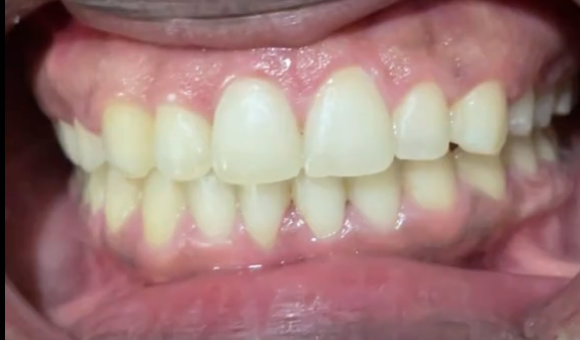 Teeth before professional whitening
